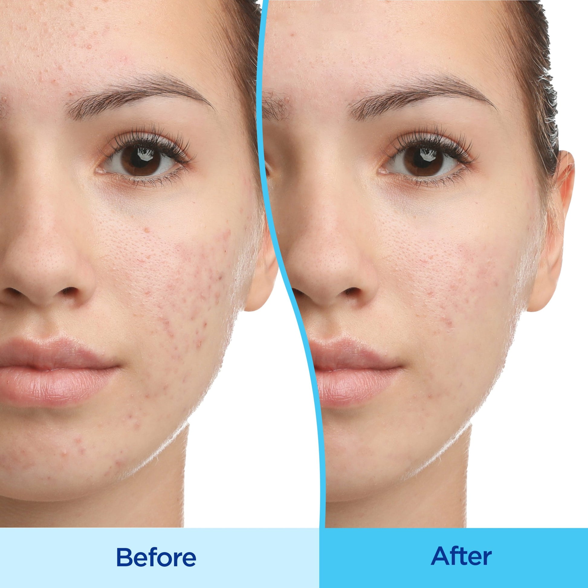 Differin Gel Acne Treatment 15g