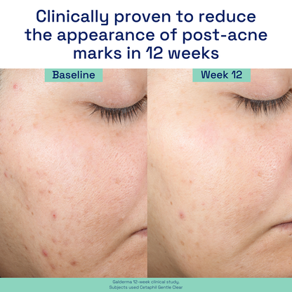 Cetaphil Gentle Clear Repairing Post-Acne Serum 30ml