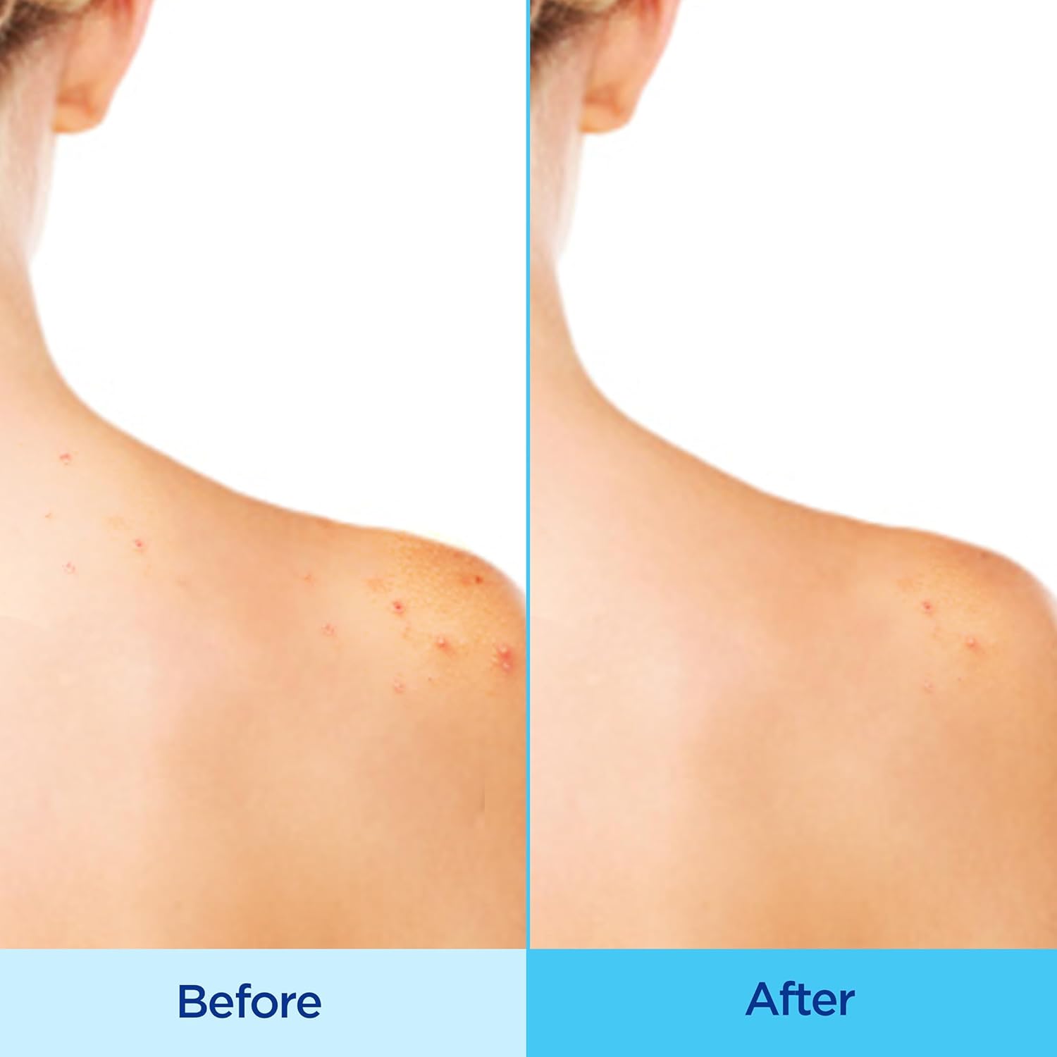 Differin Acne Clearing Body Spray with 2% Salicylic Acid 170g