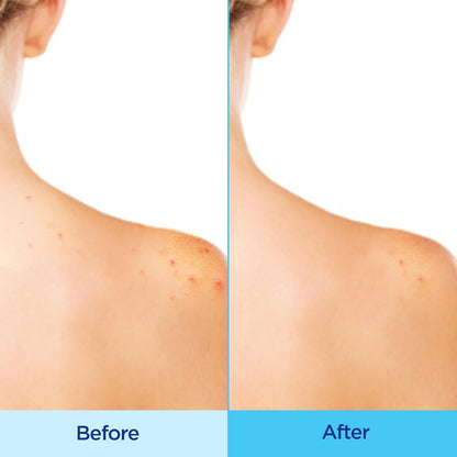 Differin Acne Clearing Body Spray with 2% Salicylic Acid 170g