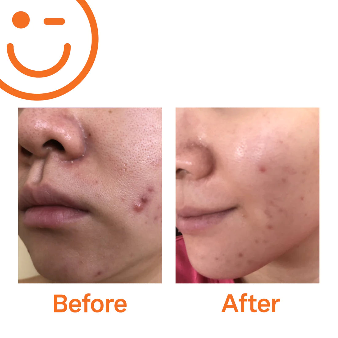 Kate Somerville Eradikate Daily Foaming Cleanser Acne Treatment 120ml