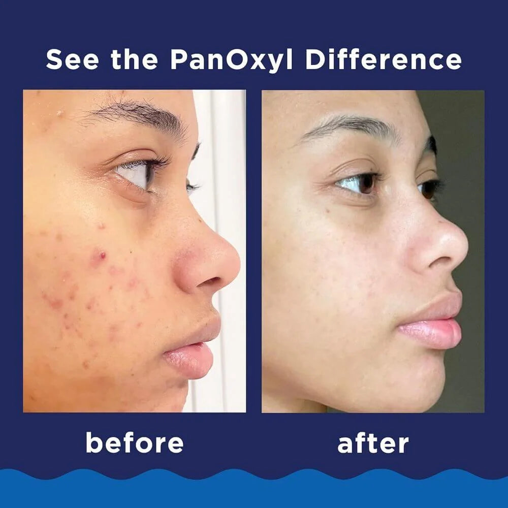 PanOxyl Acne Foaming Wash 10% Benzoyl Peroxide 156g