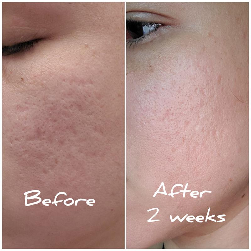 Does Differin Resurfacing Scar Gel Work Differin Resurfacing Scar Gel 30ml – Meharshop